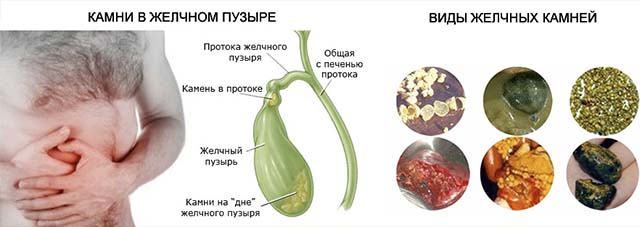 Камни в желчном пузыре