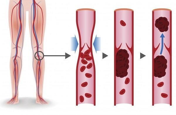 Механизм развития тромбоза глубоких вен