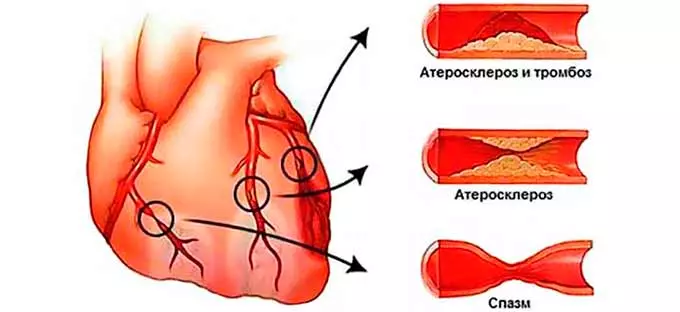 Поражение и закупорка сосудов сердца