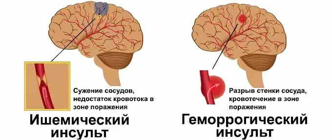 Инсульты