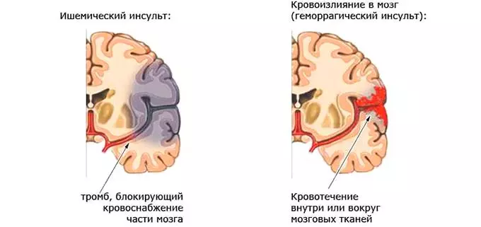Острые нарушения головного мозга
