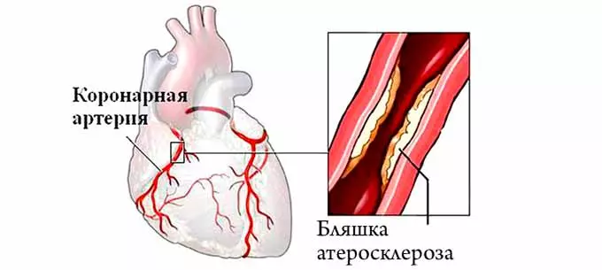 Закупорка коронарной артерии сердца