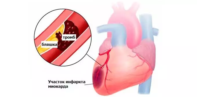 Инфаркт миокарда