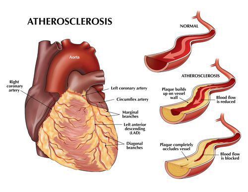Развитие стенокардии при ограничении кровотока в сосудах сердца