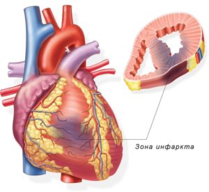 Классификация инфаркта миокарда: все виды и их особенности