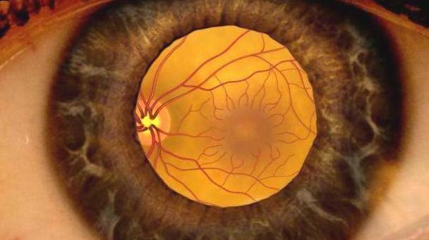 нгиопатия сетчатки обоих глаз гипертоническая
