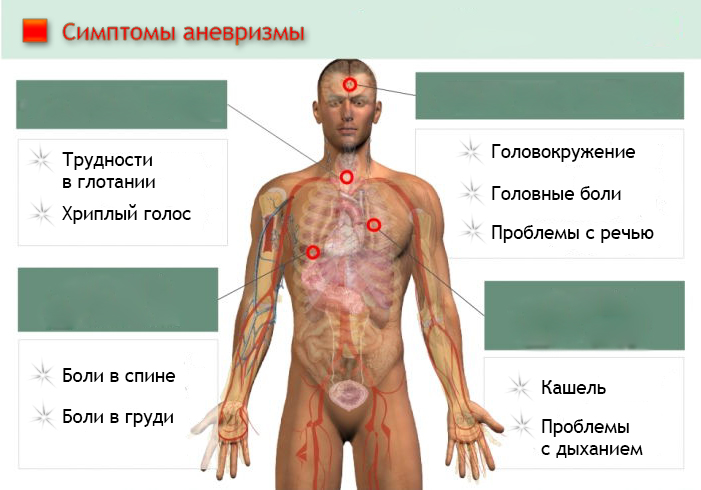 Список основных симптомов аневризмы кровеносных сосудов