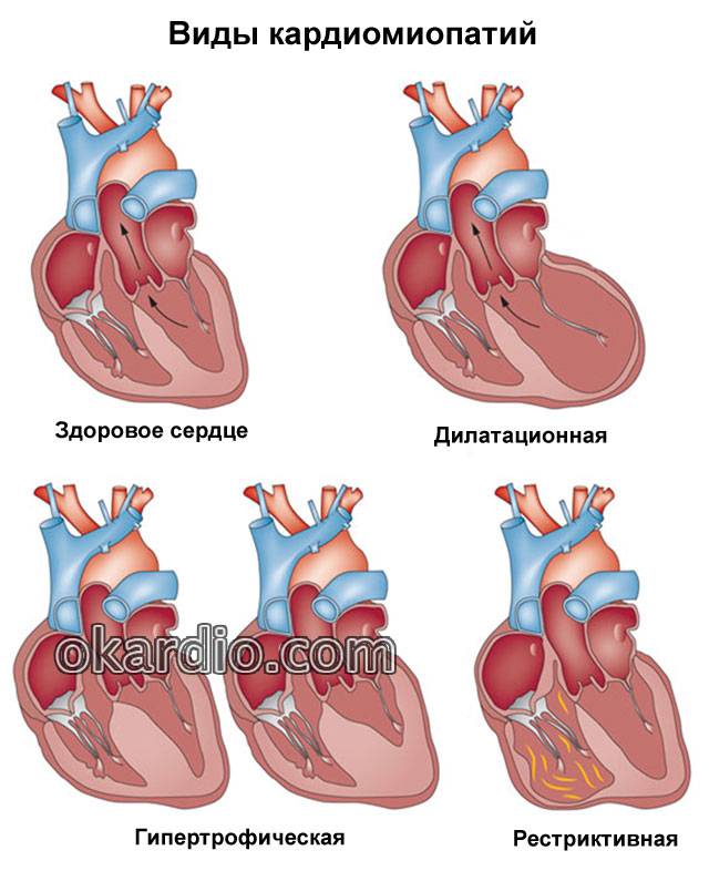 виды кардиомиопатий
