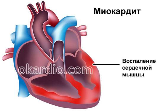 миокардит сердца