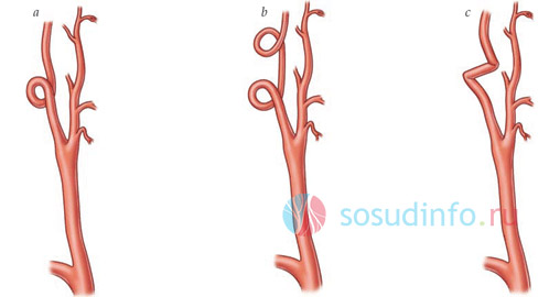 Различные формы извитости артерий. Под пунктом "c" - кинкинг