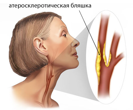 Атеросклероз шейного отдела позвоночника лечение