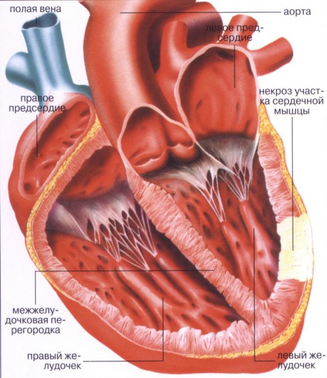 Ткани сердца испытывают дефицит кислорода и питательных веществ и перестают выполнять свою функцию