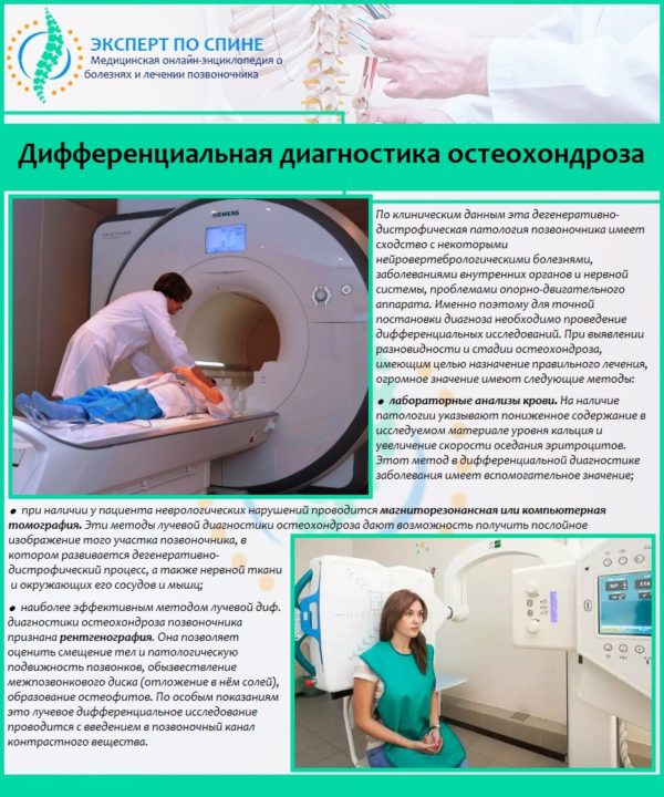 Дифференциальная диагностика остеохондроза