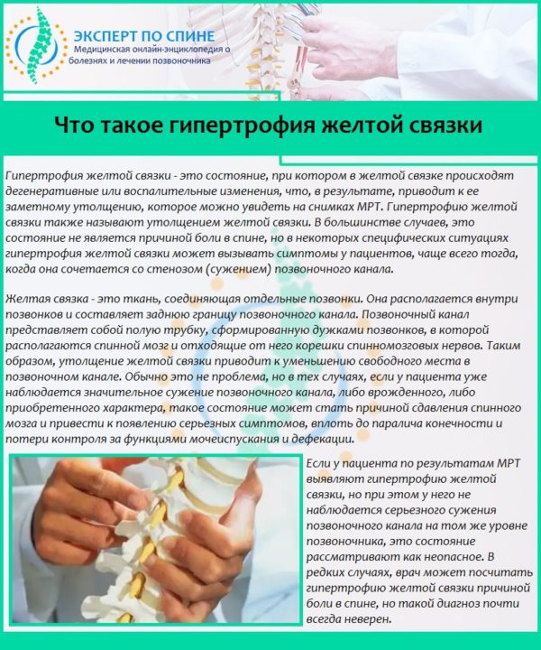Что такое гипертрофия желтой связки