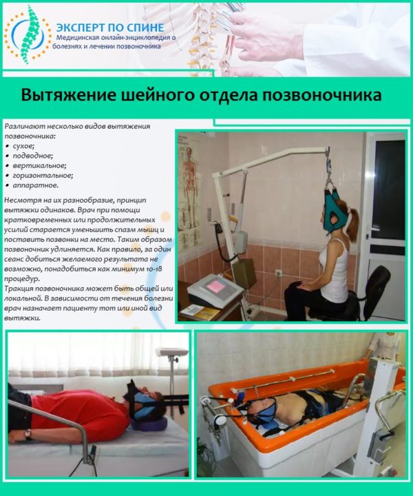 Вытяжение шейного отдела позвоночника