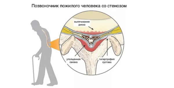 Дегенеративный стеноз - следствие естественного процесса старения позвоночника