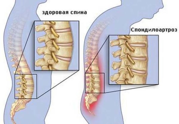 Спондилоартроз