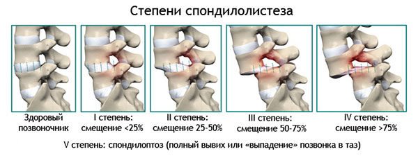 Спондилолистез