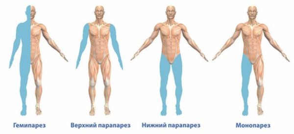 Виды парезов