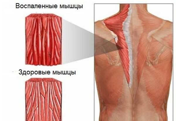 Миозит - воспаление мышц