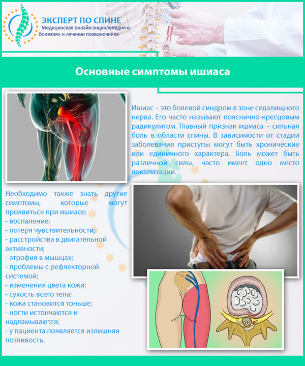 Основные симптомы ишиаса
