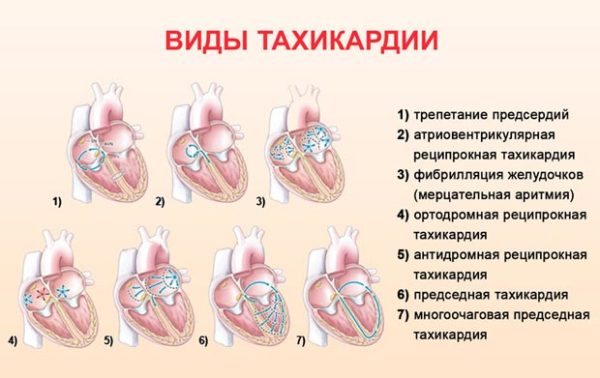 Виды тахикардии