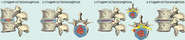 Стадии остеохондроза