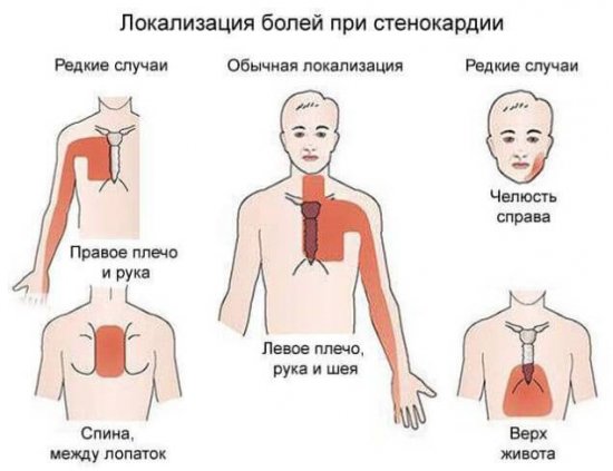 Боль при стенокардии