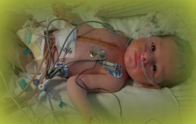Ребенок после операции на сердце
