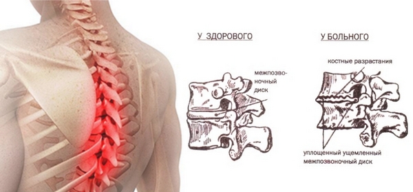 При остеохондрозе также может ощущаться боль в груди слева