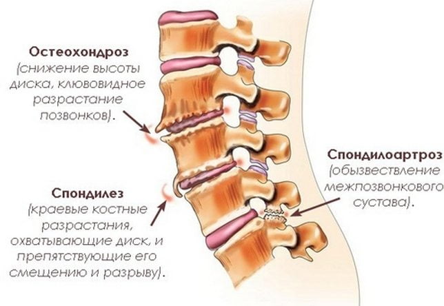 Болезни позвоночника