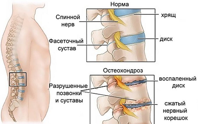 Остеохондроз позвоночника