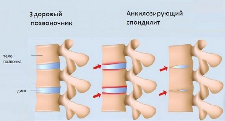 Анкилозирующий спондилит 