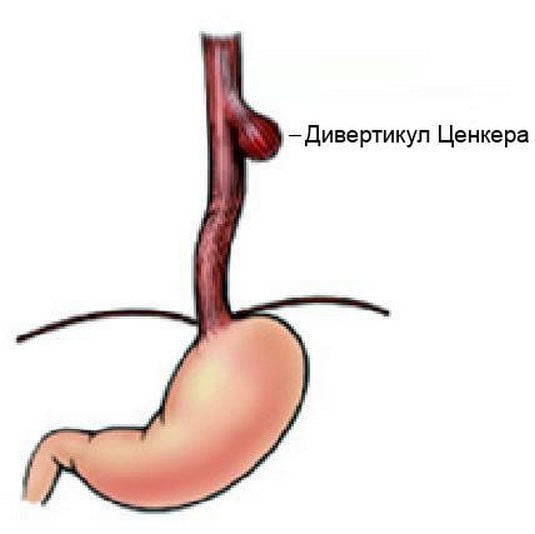 Дивертикул Ценкера