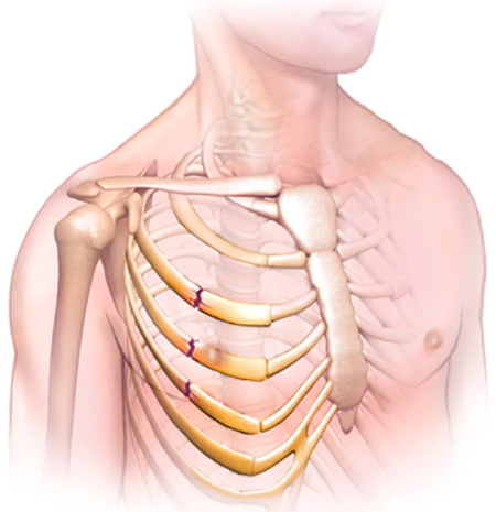 Перелом ребер
