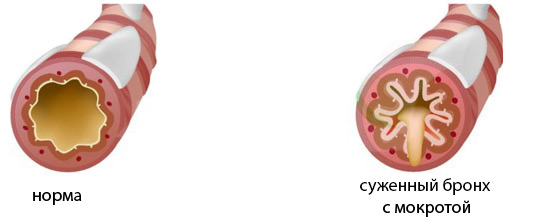 мокрота, сужение и патологические изменения элементов воздухоносных путей - причины появления хрипов при дыхании