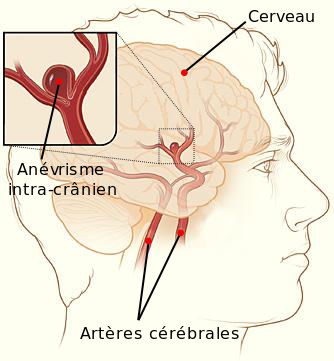 Fichier:Cerebral aneurysm-fr.svg