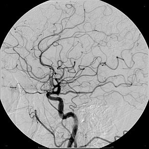 Cerebral Angiogram Lateral.jpg