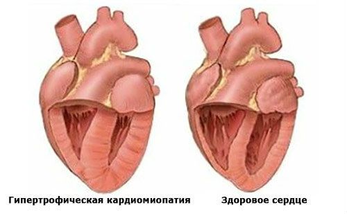 Кардиомиопатия