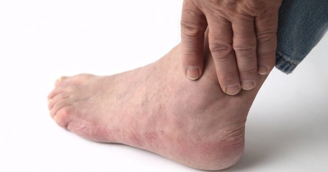 Отеки ног – все возможные причины и лучшее лечение