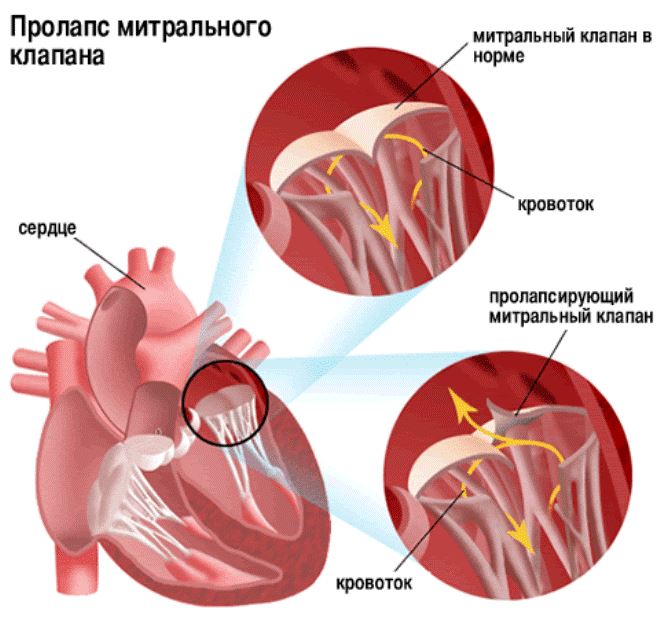 Что такое пролапс митрального клапана сердца