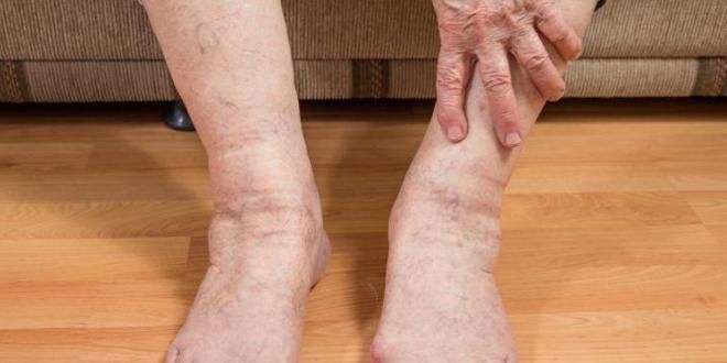отечность ног в пожилом возрасте