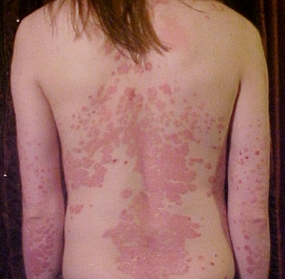 Does Ayurveda heal psoriasis?