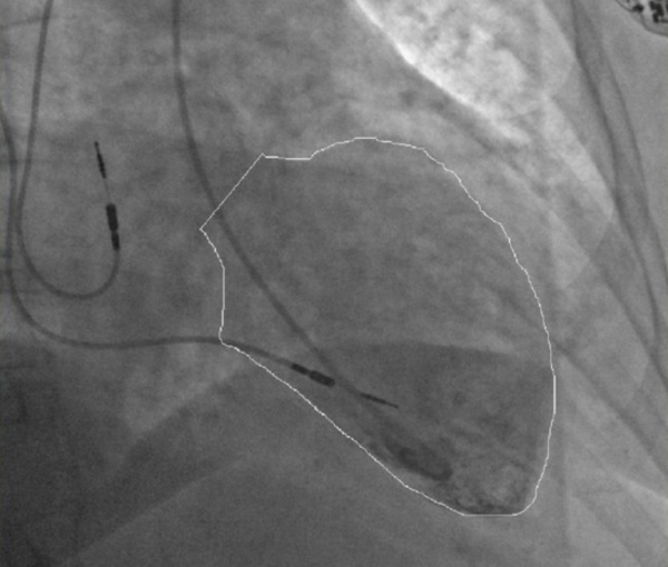 Вентрикулография. Типичная для кардиомиопатии такоцубо форма расширения верхушки левого желудочка.
