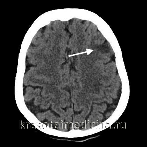 На аксиальной КТ в левой теменной доле (в бассейне средней мозговой артерии слева, М4) определяется гиподенсный участок с нарушенной дифференцировкой серого и белого вещества, типичный для ишемического инсульта в острой фазе