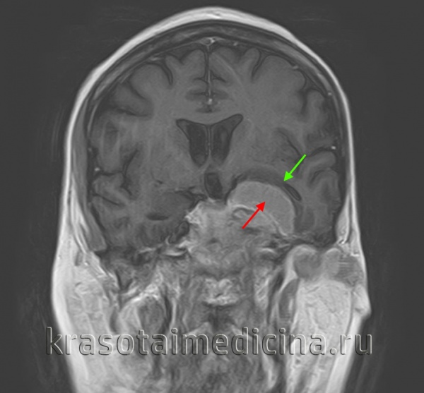 МРТ ГМ. Сдавление височной доли (зеленая стрелка) головного мозга объемным образованием (красная стрелка)