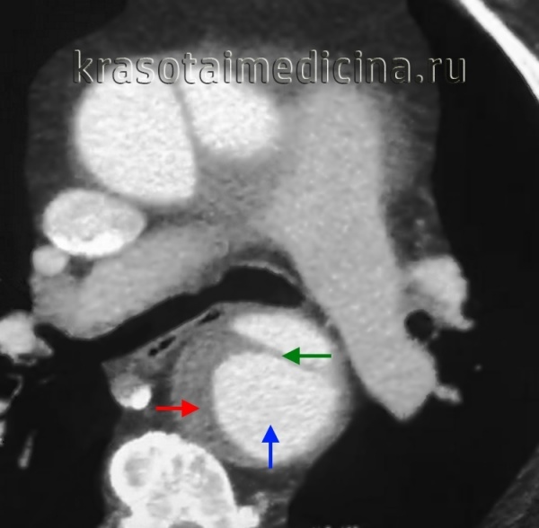 КТ-ангиография грудной аорты. Синяя стрелка – просвет аорты, красная стрелка – пристеночный тромб, зеленая стрелка – отслоившаяся интима.