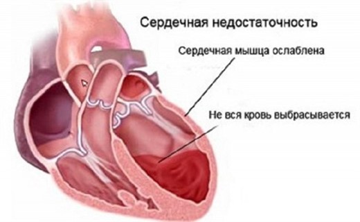 Острая сердечная недостаточность клиника	