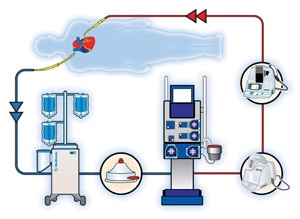 A patient placed on cardiopulmonary bypass (the heart lung machine) during conventional open heart surgery. The Performer<sup>®</sup> CPB System, an advanced heart-lung machine, takes over the job of keeping oxygen-rich blood circulating throughout the body during conventional CABG surgery. This allows the surgeon to perform the surgery on a still heart.