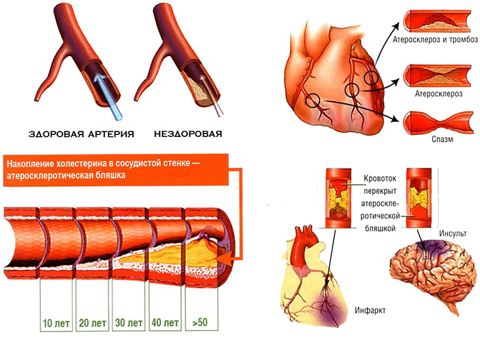 Факторы атеросклероза при ишемической болезни сердца